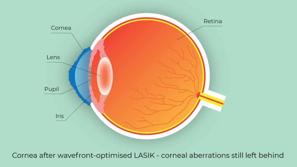 Cornea after wavefront-optimised LASIK - corneal aberrations still left behind