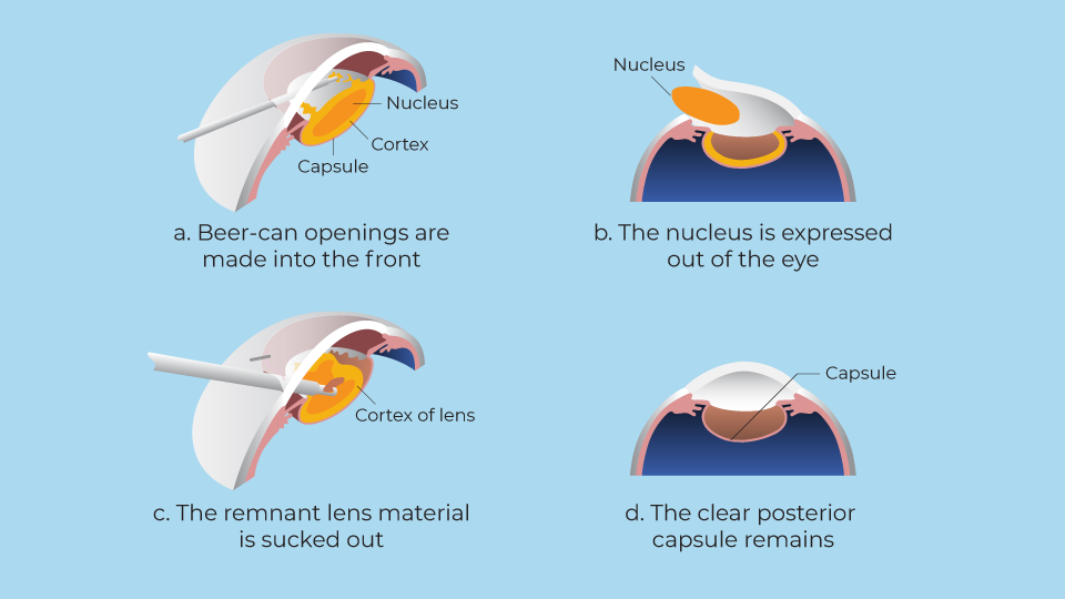 Jerry Tan Eye Surgery Singapore How Is Cataract Surgery Done